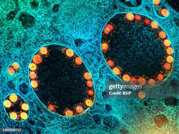 Transmission electron micrograph of SARS-CoV-2 virus particles within endosomes of a heavily infected nasal Olfactory Epithelial Cell. Image captured...