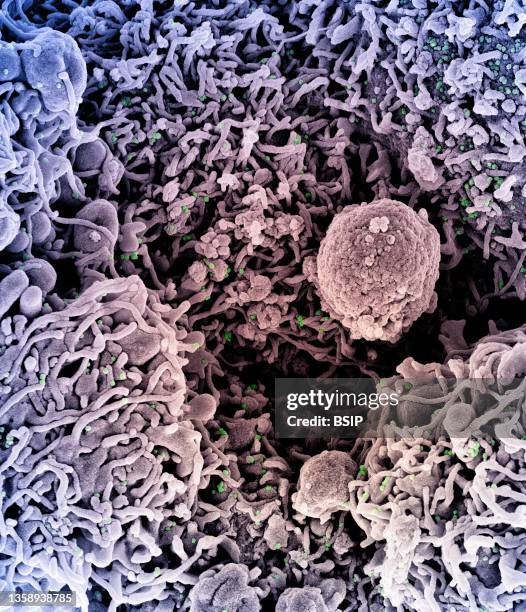 Colorized scanning electron micrograph of a cell infected with a variant strain of SARS-CoV-2 virus particles , isolated from a patient sample. Image...