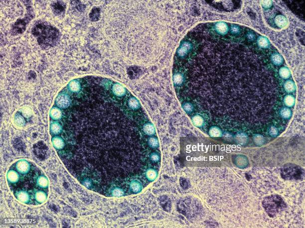 Transmission electron micrograph of SARS-CoV-2 virus particles within endosomes of a heavily infected nasal Olfactory Epithelial Cell. Image captured...
