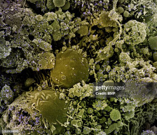 Colorized scanning electron micrograph of chronically infected and partially lysed cells infected with a variant strain of SARS-CoV-2 virus particles...