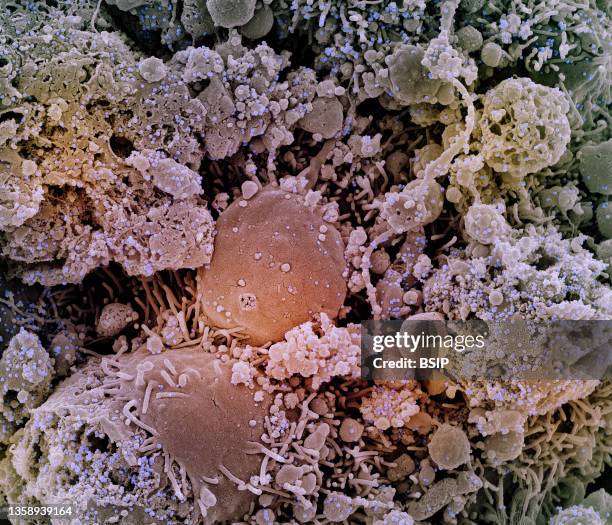 Colorized scanning electron micrograph of chronically infected and partially lysed cells infected with a variant strain of SARS-CoV-2 virus particles...