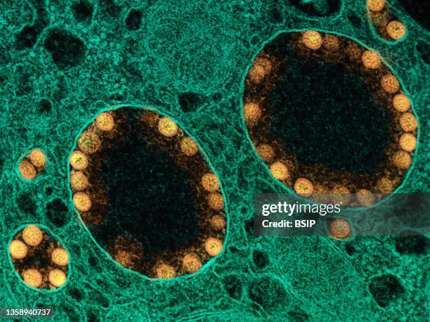 Transmission electron micrograph of SARS-CoV-2 virus particles within endosomes of a heavily infected nasal Olfactory Epithelial Cell. Image captured...