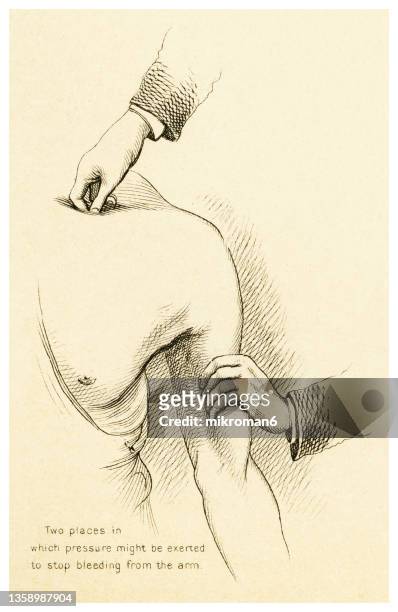 old engraved illustration of methods of arresting bleeding - two places in which pressure might be exerted to stop bleeding from the arm - tourniquet stock pictures, royalty-free photos & images
