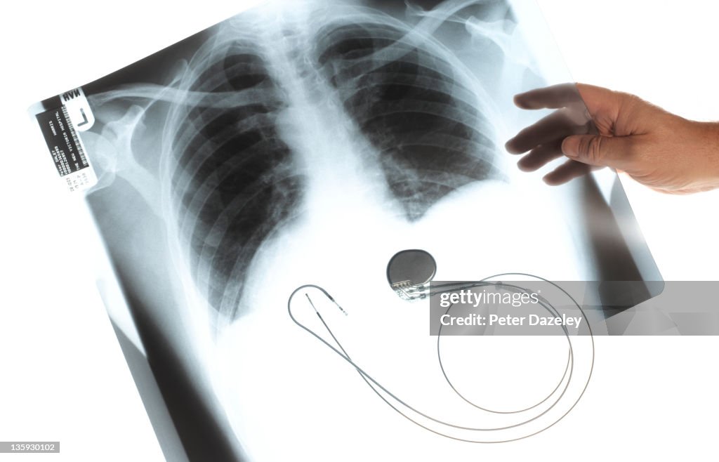 Heart Pacemaker On Xray Of Lungs High-Res Stock Photo - Getty Images