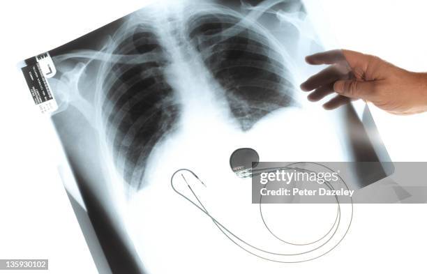 heart pacemaker on xray of lungs - pacemaker stock pictures, royalty-free photos & images