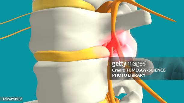 disc prolapse, illustration - human vertebra stock illustrations