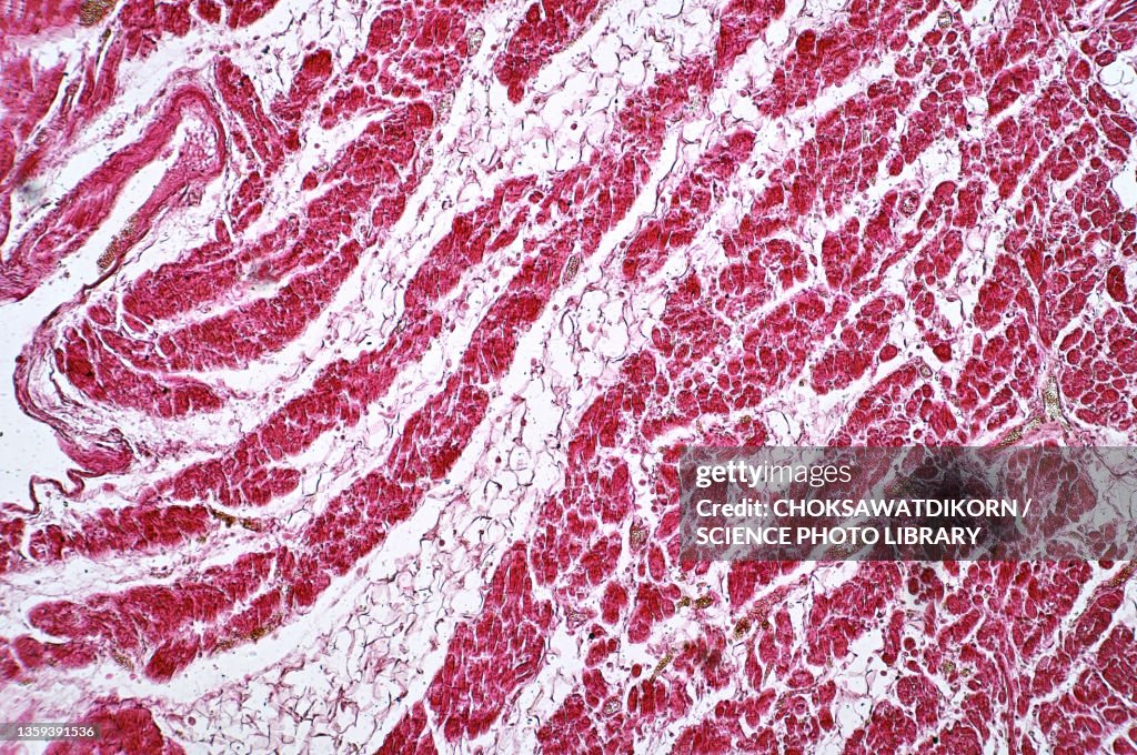 Fatty heart, light micrograph