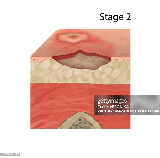 ilustrações de stock, clip art, desenhos animados e ícones de stage 2 pressure sore, illustration - úlcera de pressão