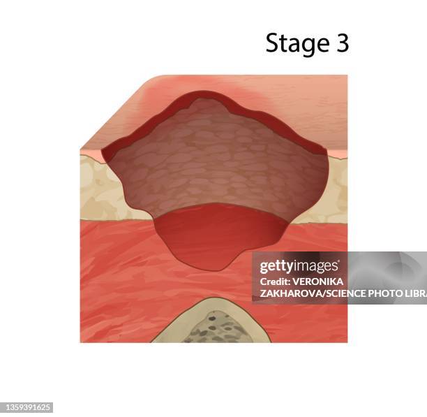 stockillustraties, clipart, cartoons en iconen met stage 3 pressure sore, illustration - pressure ulcer