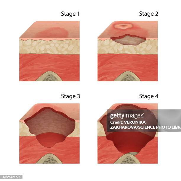 ilustraciones, imágenes clip art, dibujos animados e iconos de stock de pressure sore stages, illustration - ulcer