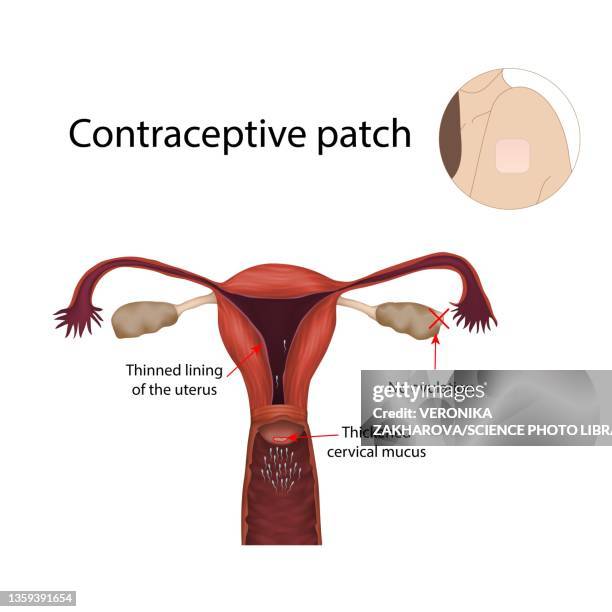 ilustraciones, imágenes clip art, dibujos animados e iconos de stock de contraceptive patch, illustration - contraceptive patch