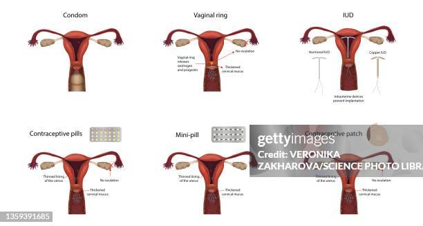 illustrations, cliparts, dessins animés et icônes de contraception methods, illustration - stérilet