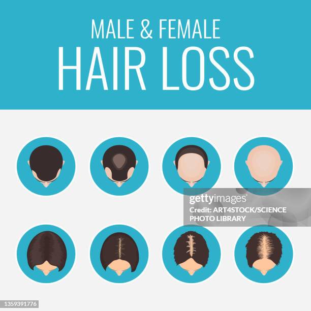 female and male pattern alopecia, illustration - science stock illustrations stock-grafiken, -clipart, -cartoons und -symbole