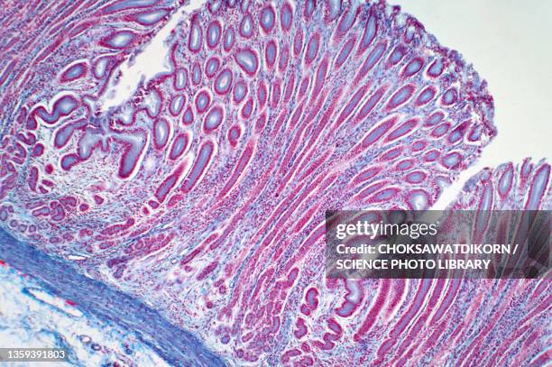 colon biopsy, light micrograph - biopsy fotografías e imágenes de stock