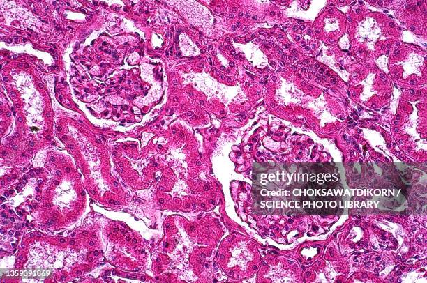 glycogenosis, light micrograph - hepatitis fotografías e imágenes de stock