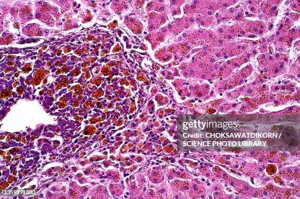 abnormal liver cells, light micrograph - cirrhosis 個照片及圖片檔