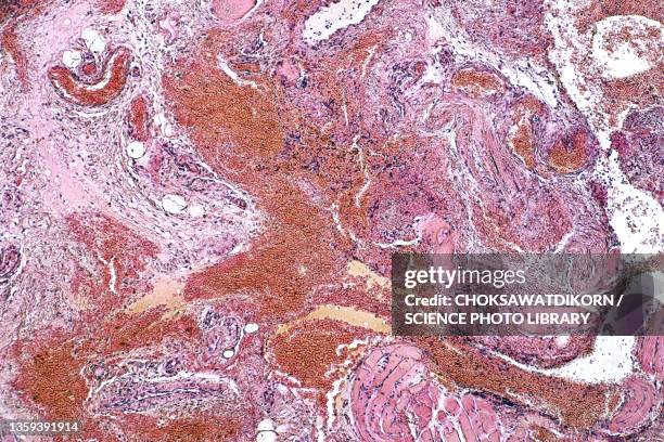 tonsilitis, light micrograph - squamous epithelium stock pictures, royalty-free photos & images