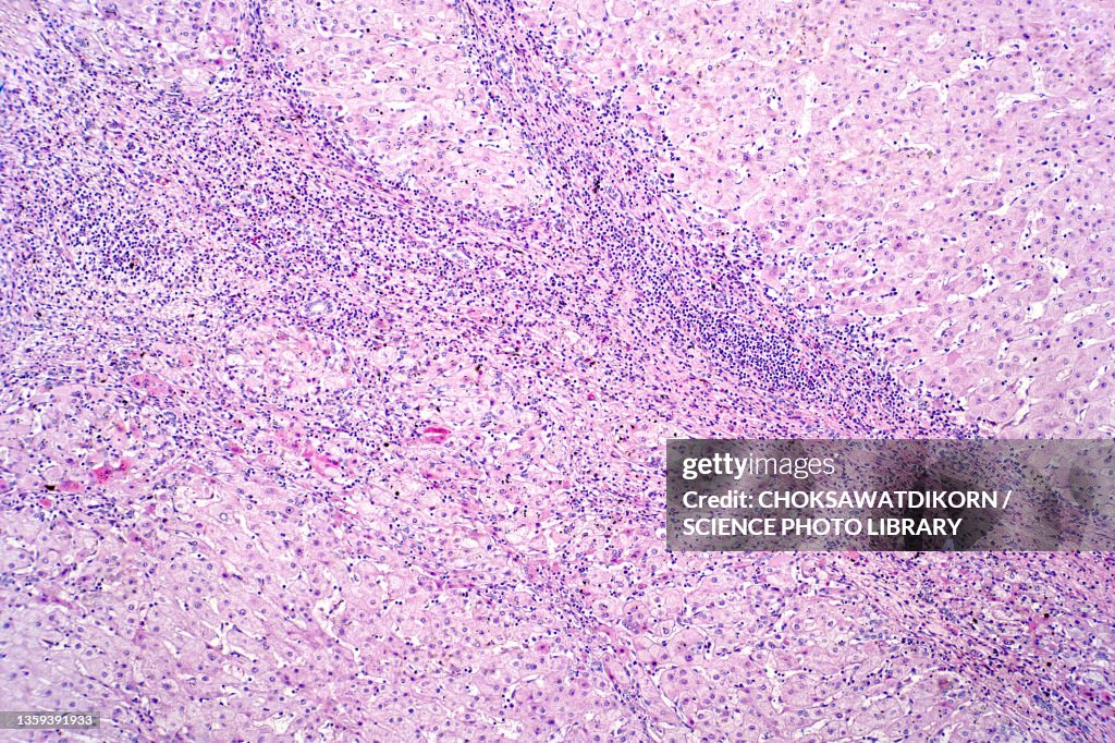 Liver cirrhosis, light micrograph