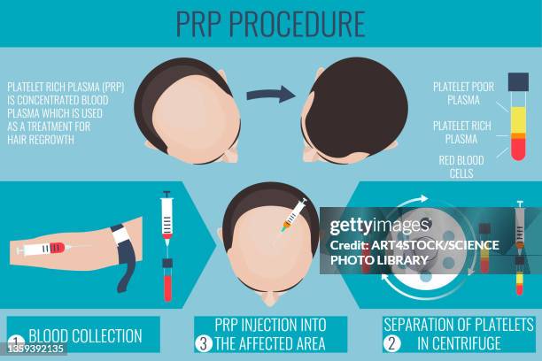 platelet rich plasma male hair loss treatment, illustration - alternative therapy stock illustrations