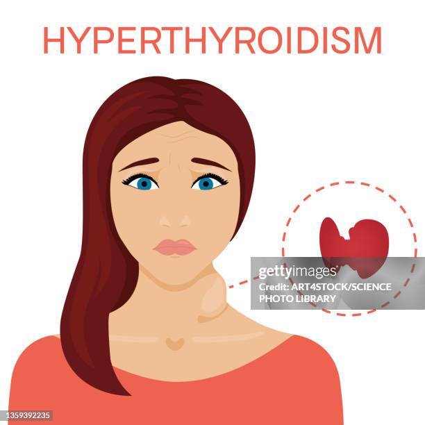 ilustraciones, imágenes clip art, dibujos animados e iconos de stock de woman with hyperthyroidism, illustration - goiter