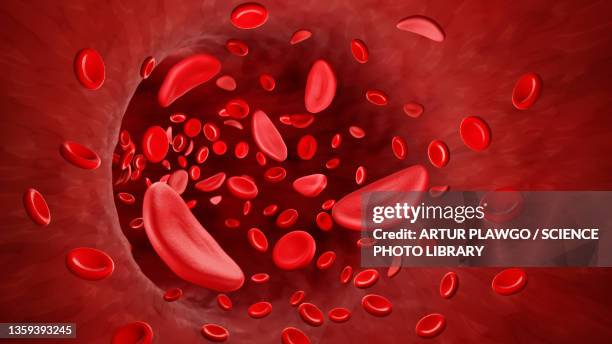 ilustraciones, imágenes clip art, dibujos animados e iconos de stock de sickle cell anaemia, illustration - anemia