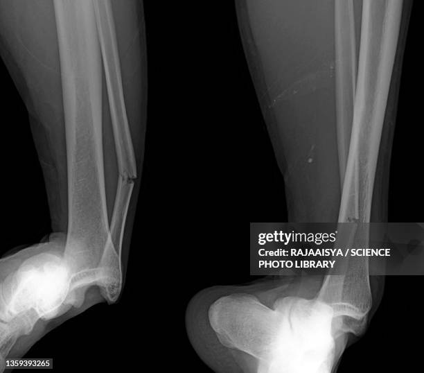 dislocated ankle, x-ray - knöchel stock-fotos und bilder