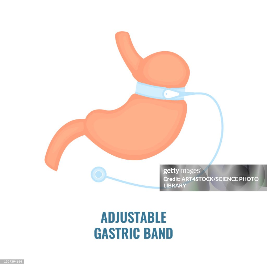 Adjustable gastric band bariatric surgery, illustration