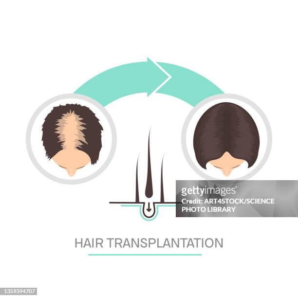 hair transplantation in women, conceptual illustration - haartransplantation stock-grafiken, -clipart, -cartoons und -symbole
