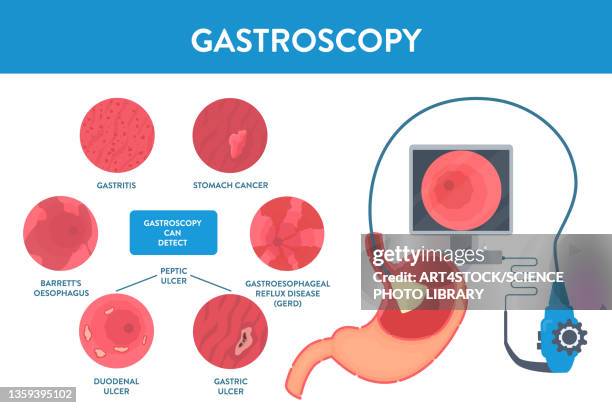 Escopy Endoscope Esophagus Photos and Premium High Res Pictures - Getty Images