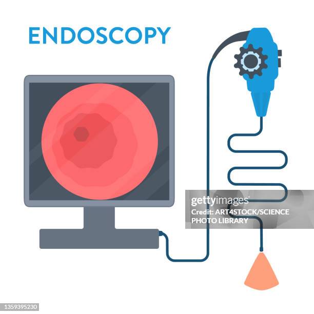 endoscopy, conceptual illustration - 内視鏡点のイラスト素材／クリップアート素材／マンガ素材／アイコン素材