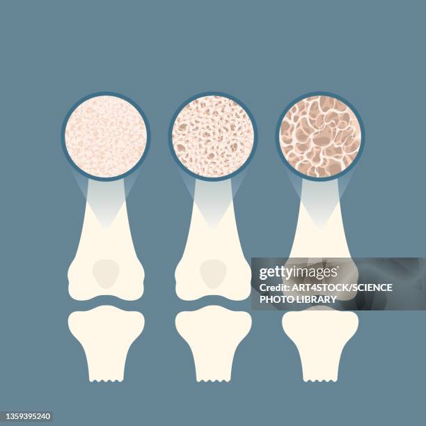 ilustraciones, imágenes clip art, dibujos animados e iconos de stock de osteoporosis, conceptual illustration - femur