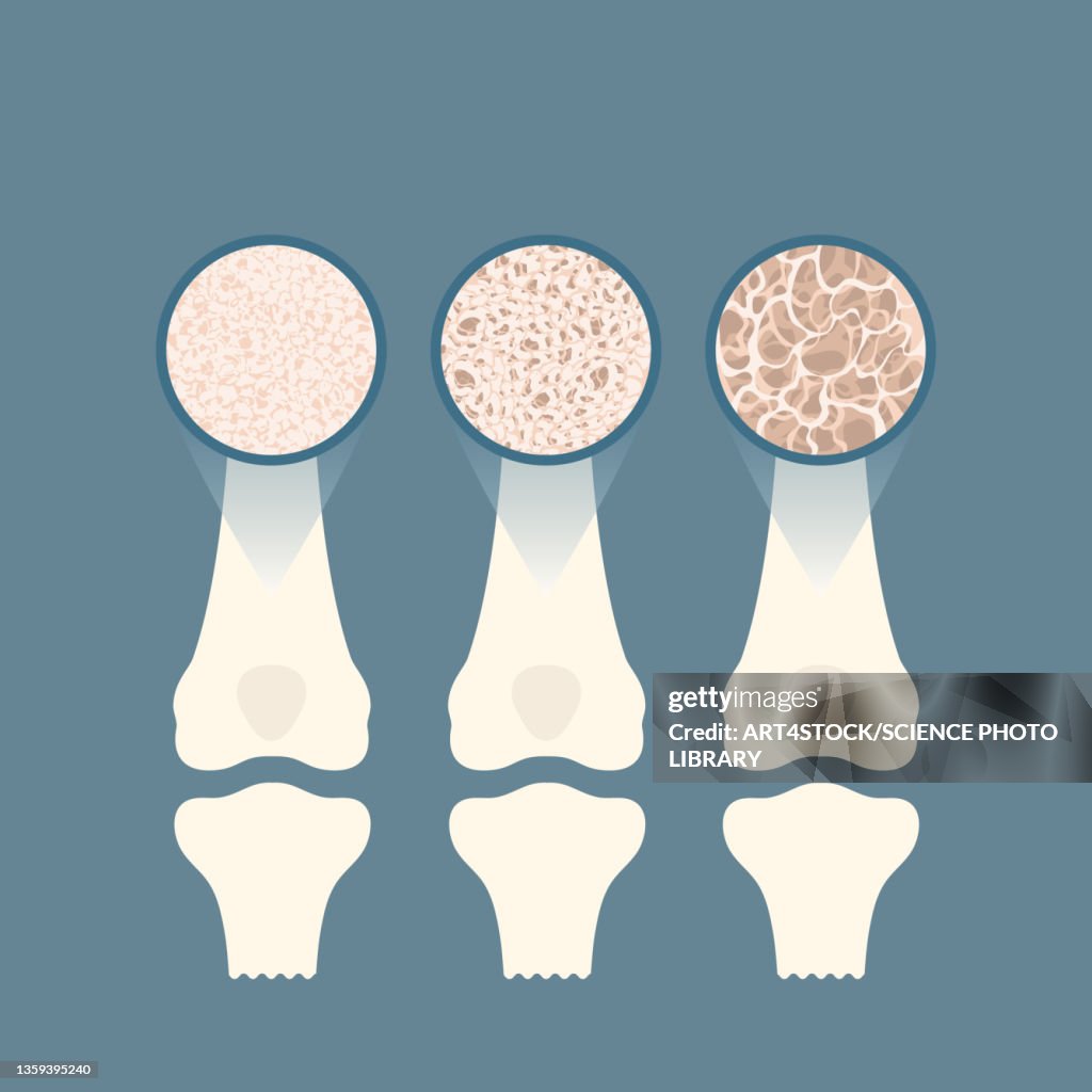 Osteoporosis, conceptual illustration