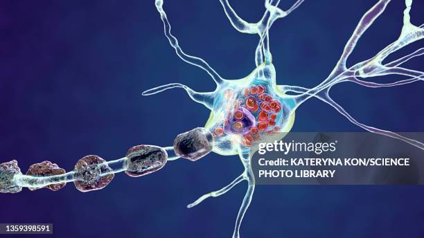 neurons in tay-sachs disease, illustration - tay sachs stock-grafiken, -clipart, -cartoons und -symbole