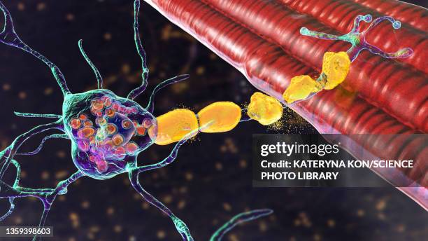 neurons in tay-sachs disease, illustration - tay sachs stock-grafiken, -clipart, -cartoons und -symbole