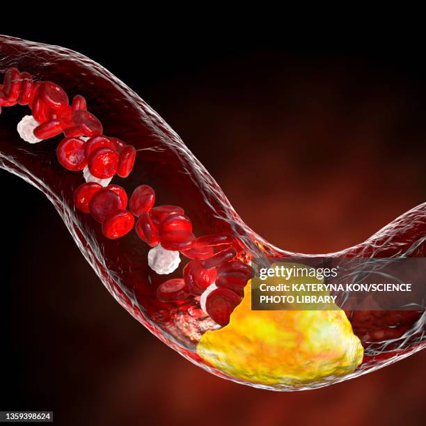 atherosclerosis, illustration - blutgefäss stock-grafiken, -clipart, -cartoons und -symbole