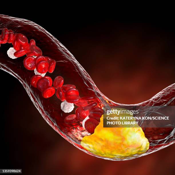 stockillustraties, clipart, cartoons en iconen met atherosclerosis, illustration - cholesterol