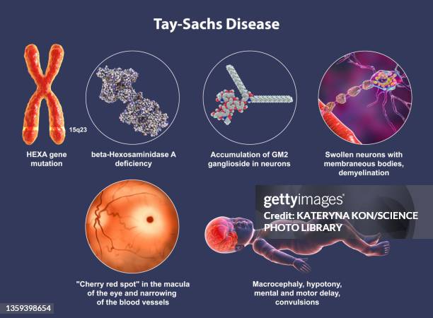 tay-sachs disease, illustration - tay sachs stock-grafiken, -clipart, -cartoons und -symbole