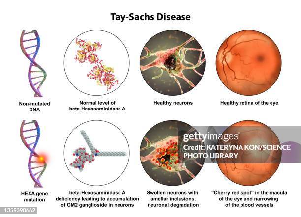 tay-sachs disease, illustration - tay sachs stock-grafiken, -clipart, -cartoons und -symbole
