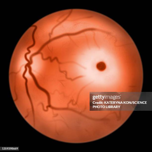 eye retina in tay-sachs disease, illustration - tay sachs stock-fotos und bilder