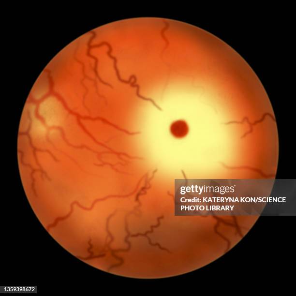 eye retina in tay-sachs disease, illustration - tay sachs stock-fotos und bilder