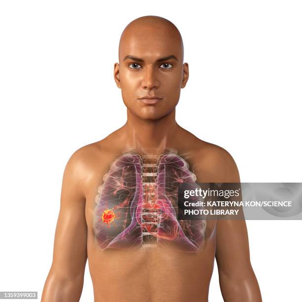 stockillustraties, clipart, cartoons en iconen met lung cancer, illustration - abces