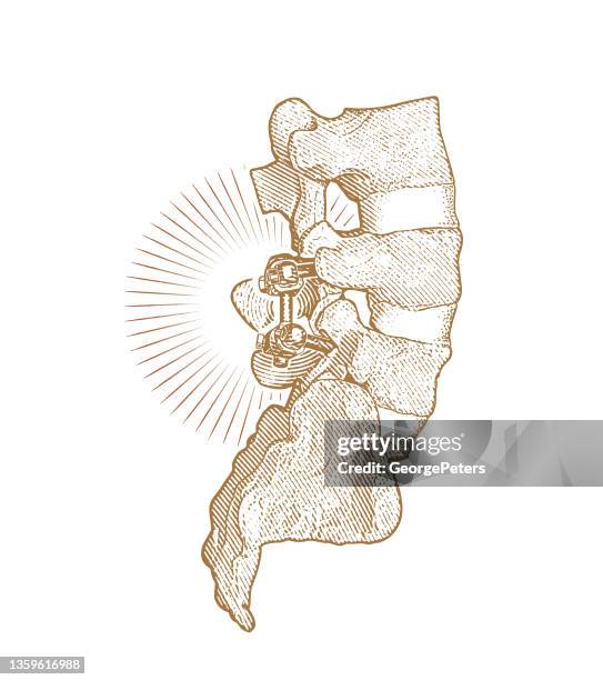 lumbar fusion surgery - lumbar vertebra stock illustrations
