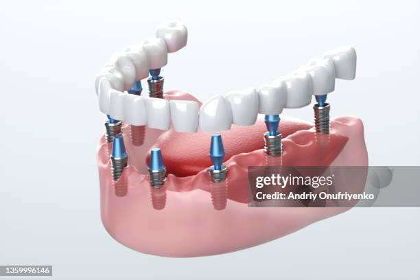 ceramic dental veneers installation - implante dentário imagens e fotografias de stock
