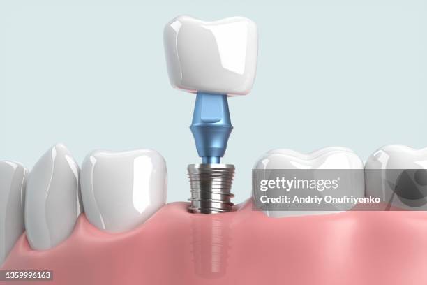 implant tooth installation - dental crown stock pictures, royalty-free photos & images