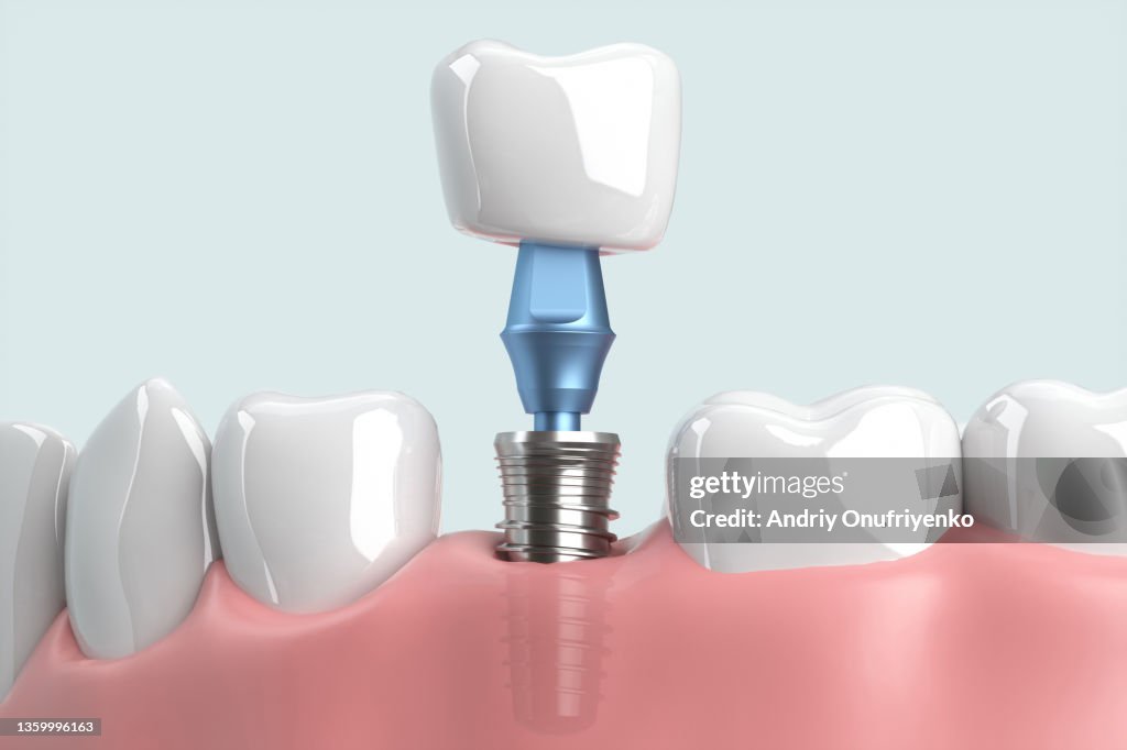 Implant tooth installation
