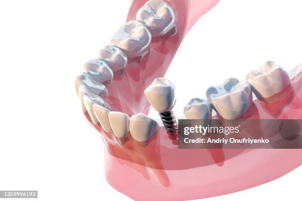 implant tooth installation - dentalimplantat stock-fotos und bilder