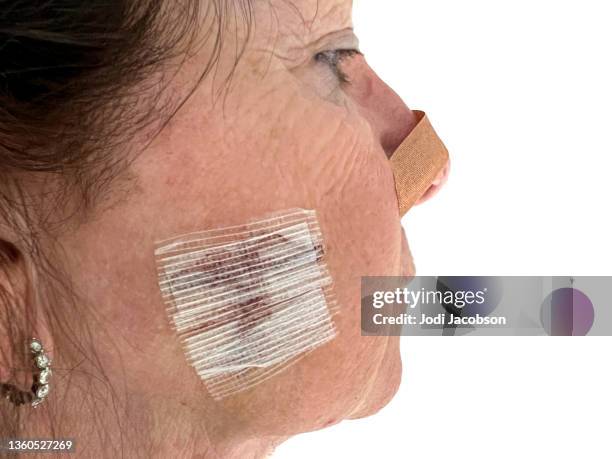 series-medical: mohs surgery on senior woman's face - basalcellscancer bildbanksfoton och bilder