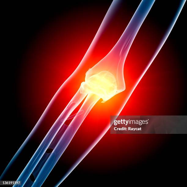 elbow in pain x-ray - 肘 個照片及圖片檔