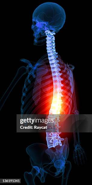 backache - cauda equina syndrome stock pictures, royalty-free photos & images
