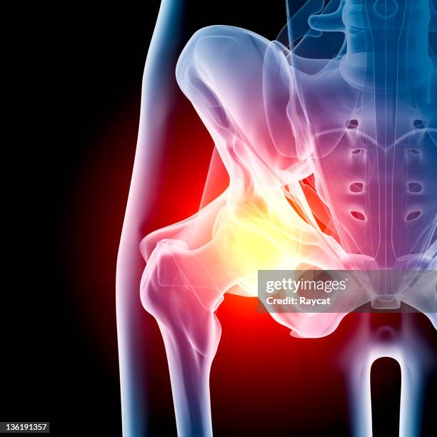 hip in pain x-ray - ontsteking medische aandoening stockfoto's en -beelden